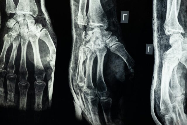 xray of hand